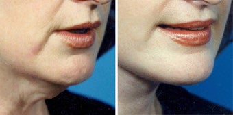Neck Lift