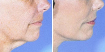 Neck Lift