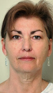 Before and After Neck Lift (Front View)
