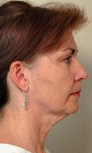 Before and After Neck Lift (Side View)