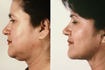 Necklift with Jowl Liposuction