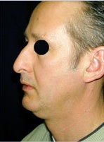 Neck Lift and Fat Transfer
