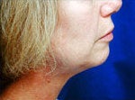 Neck Lift