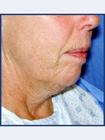 Neck Lift and Chin Implant