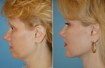 Neck Lift and Chin Implant