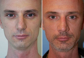 Rhinoplasty, Chin Implant