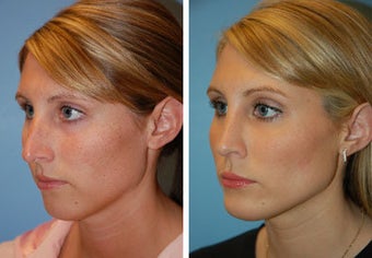 Chin Implant, Rhinoplasty