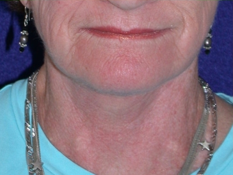 Necklift