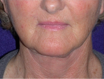 Necklift