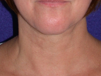 Necklift