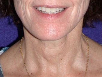 Necklift