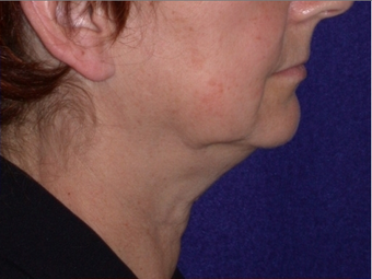 Necklift