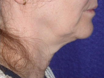Necklift