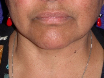 Necklift