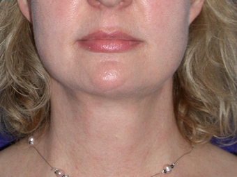 Necklift