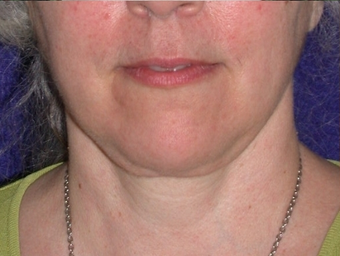 Necklift