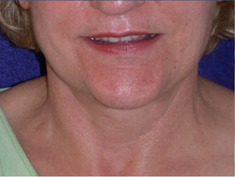 Necklift