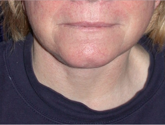 Necklift