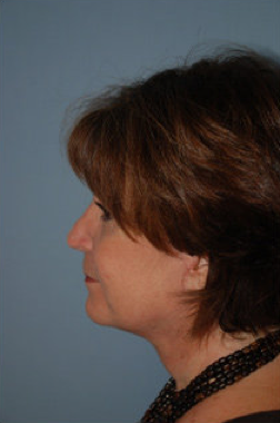 Neck Lift
