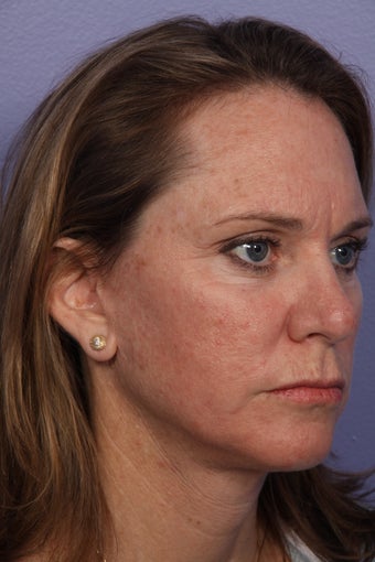 Neck Lift