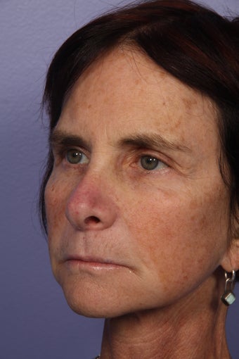 Neck lift