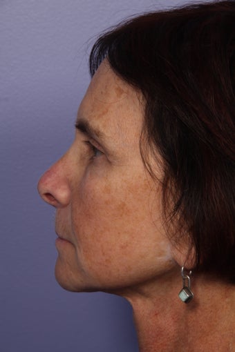 Neck lift