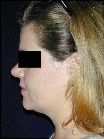 Neck Liposculpture