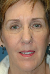 Neck Lift Surgery