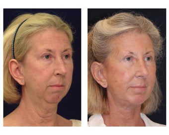 Neck Lift