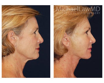 Neck Lift