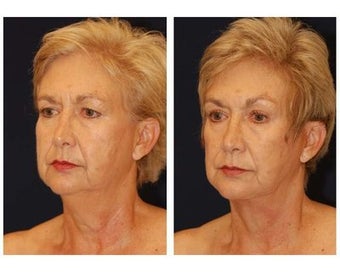 Neck Lift