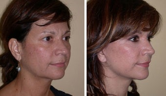 Necklift 