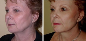 Necklift