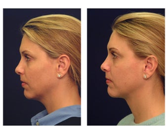 Neck Lift & Lower Facial Rejuvenation