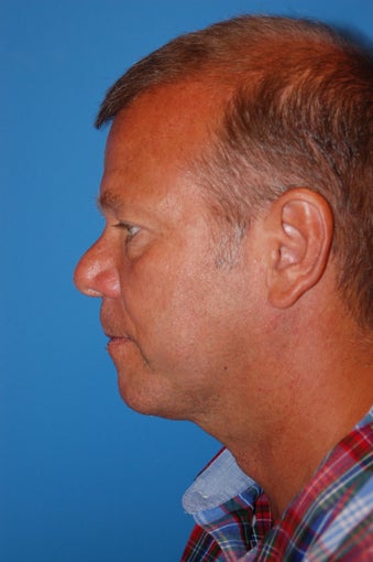 Necklift