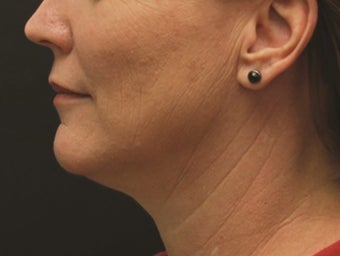 Neck Lift and Laser-Assised Lipocontouring