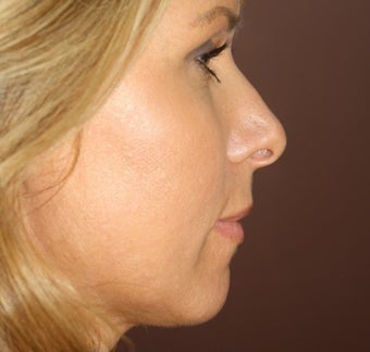 Neck Lift and Upper Eyelid Blepharoplasty