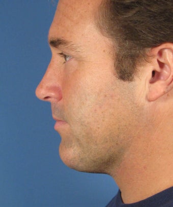 Neck lift
