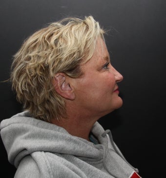 neck lift