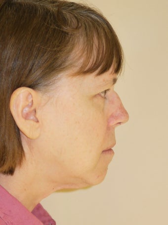 Neck Liposuction