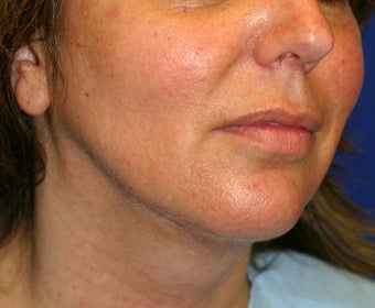 Neck Liposuction