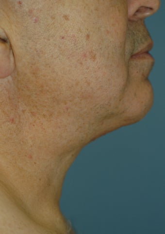 Neck Lift
