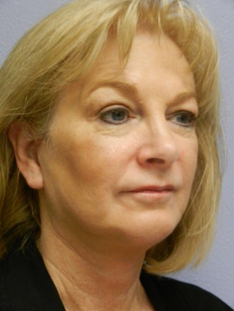 Neck Lift 
