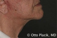 Cervicoplasty
