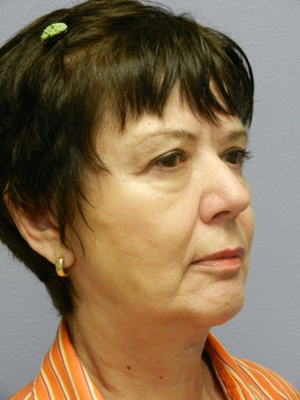 Lower Face Neck Lift 
