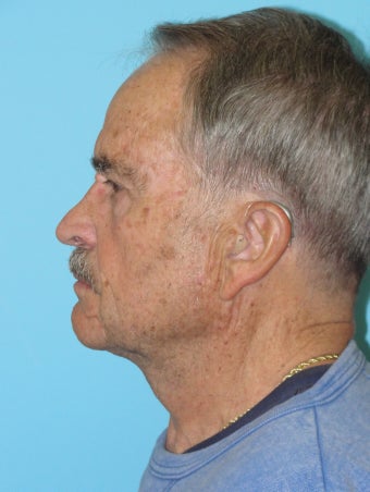 Necklift