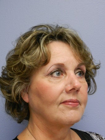 Neck Lift 