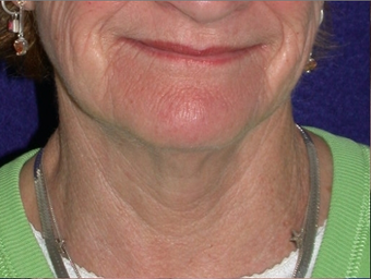 Necklift