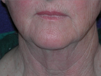 Necklift