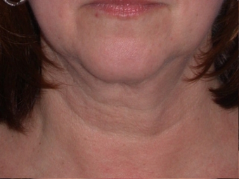 Necklift
